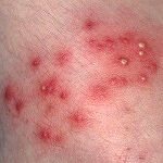 mrsa-skin-infection MRSA skin infection