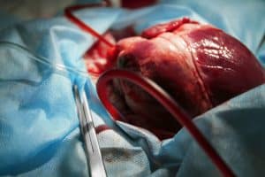 heart transplant expert witness